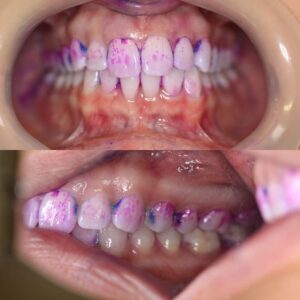 Airflow clean dentist Ettalong