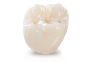 dental crowns Ettalong dental crowns Kincumber