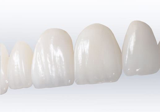 Veneers Ettalong Veneers Kincumber