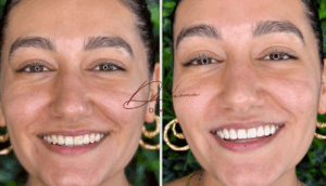 veneers EttalongVeneers Kincumber