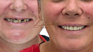 dental implants Ettalongdental implants Kincumber