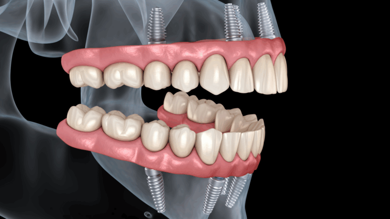 all on 4 Ettalong all on 4 Kincumber