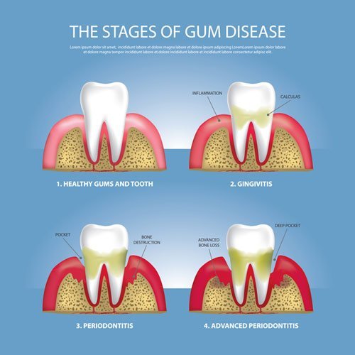 gum disease care in ettalong