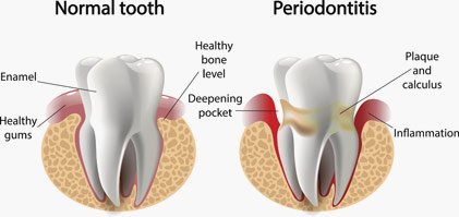 periodontitis care in ettalong