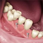 Dental Implants 2
