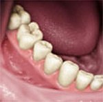 Dental Implants 3