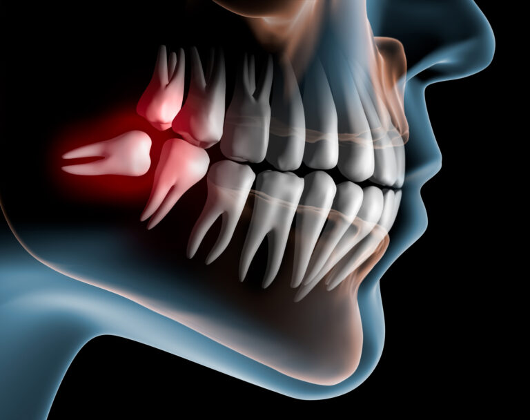 Lying Wisdom Tooth In The Lower Jaw 3D Rendering